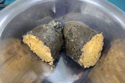 Ăn nhiều quả hồng ngâm, người phụ nữ phải phẫu thuật dạ dày lấy khối bã