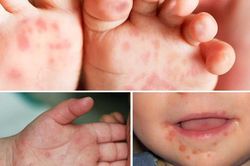 Đắk Lắk: Số ca bệnh tay chân miệng tăng cao
