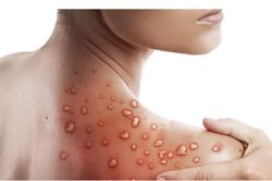 Ca đậu mùa khỉ đầu tiên tại Việt Nam là bệnh nhân nữ mới nhập cảnh