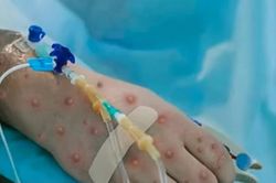 Bệnh nhân đầu tiên mắc đậu mùa khỉ tại Việt Nam đã âm tính