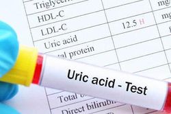 Người đàn ông hoang mang khi chỉ số acid uric tăng đột biến mà chưa có triệu chứng gout