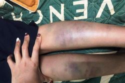 Học sinh bị bầm tím chân tay ở Đà Nẵng là do bạn đánh