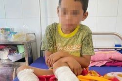 Cháu bé lớp 3 bị cha dùng xăng và rơm đốt
