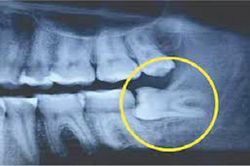 Nữ bệnh nhân tử vong sau khi nhổ 4 chiếc răng khôn cùng lúc