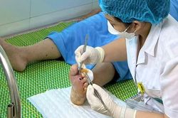 Tự đắp thuốc kháng sinh chữa đái tháo đường, một người phải tháo bỏ ngón chân