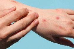 Đậu mùa khỉ có phải là bệnh lây truyền qua đường tình dục?