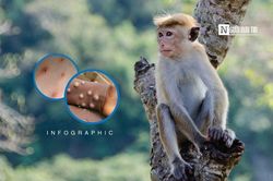 Info: Phân biệt đậu mùa khỉ và thủy đậu