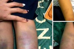Công an vào cuộc vụ học sinh bị đánh bầm tím ở trường