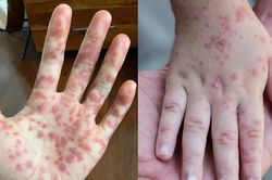 Cách phân biệt bệnh đậu mùa khỉ và bệnh thủy đậu