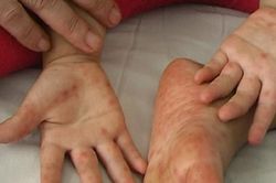 Những dấu hiệu trở nặng của trẻ mắc tay chân miệng, cha mẹ lưu ý