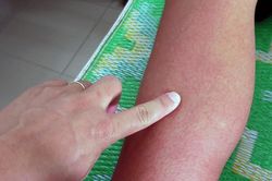 Nửa dân số thế giới có nguy cơ mắc bệnh sốt xuất huyết