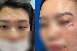 Phồng hàm, xệ mắt, nguy cơ biến chứng kéo dài vì tiêm Botox 'chỗ người quen'