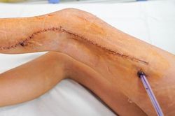 Căn bệnh nguy hiểm khiến bé gái đột ngột liệt, mất khả năng di chuyển