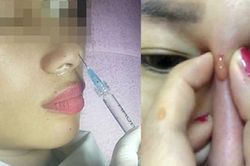 Bác sĩ cảnh báo những biến chứng sau tiêm filler nâng ngực, mũi, xóa nhăn...