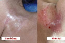 Bé gái 19 tháng tuổi bỏng nặng vì lọ dung dịch hầu hết 'nhà nào cũng có'