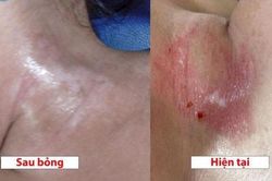 Bé gái 19 tháng tuổi bị bỏng từ chất tẩy dầu mỡ