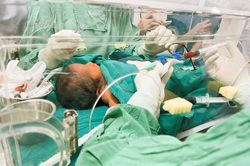 Bị vàng da, bé 3 ngày tuổi phải thay máu toàn phần