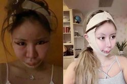 Người mẹ Nhật Bản ép con gái 9 tuổi cắt mí, làm mũi, nâng ngực