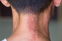 Cảnh báo tự mua thuốc điều trị bệnh Zona thần kinh tại nhà