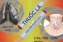 Thuốc lá - tác nhân gây nên ung thư vòm mũi họng