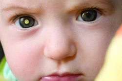 Bé 3 tuổi phải bỏ một bên mắt do sai lầm của cha mẹ