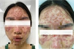 Đắp mặt nạ detox chữa trứng cá tại spa, cô gái bị tổn thương da phải nhập viện