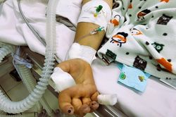 Dấu hiệu cảnh báo trẻ mắc sốt xuất huyết phải nhập viện gấp