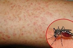 Người bệnh sốt xuất huyết nên tắm, gội như thế nào cho đúng cách?