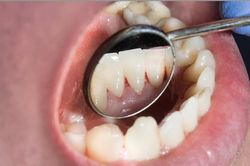 Chảy máu chân răng có thể là tín hiệu cảnh báo những căn bệnh nào?