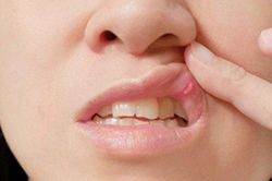 Căn bệnh nguy hiểm khiến cô gái 27 tuổi phải cắt lưỡi