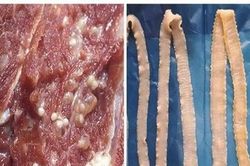 Người phụ nữ bị nhiễm loại ký sinh trùng do ăn bò tái