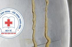 Người phụ nữ nhiễm sán dây vì thói quen ăn thịt bò tái, rau sống