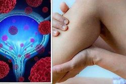 Gặp những biểu hiện này khi đi tiểu, coi chừng bệnh ung thư bàng quang đang 'tìm đến' bạn