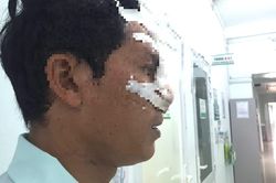Bị bạn cắn đứt mũi vì can đánh nhau trên bàn nhậu
