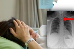 Cô gái nuốt phải dây sạc điện thoại dài 1 mét