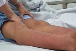 Sốt xuất huyết vào cao điểm, không tự điều trị tại nhà