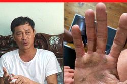 Tuyệt vọng vì viêm da ngứa gãi 'xoành xoạch', xem ngay mẹo này kẻo tiếc!