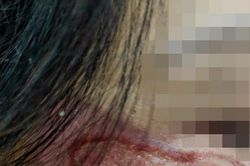 Quý bà nát hết mặt vì làm đẹp bằng dung dịch a xít