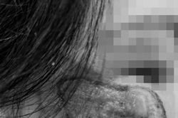 Mặt mưng mủ, nhiễm trùng do mua 'thuốc chứa axit' trị nám