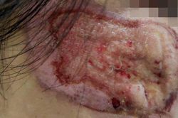 Mua thuốc chứa axit trị nám, người phụ nữ bị nhiễm trùng lở loét gò má