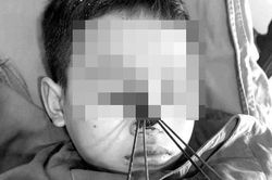 Cháu bé bị 4 mũi tên bắn vào mặt vì chiếc nỏ cướp cò khi bắt chuột đồng