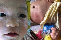 Mẹ ám ảnh vì con nổi mẩn khắp mặt, tự cào đến chảy máu vì bị dị ứng đạm sữa bò