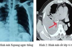 Mỏ gà chui vào phế quản do sặc, nam thực khách được các bác sỹ cứu thành công khi bị nhiễm trùng nặng