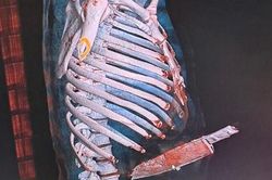 Quảng Bình: Nam thanh niên bị cây dao dài cắm xuyên giữa bụng