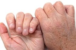 Cảnh báo tình trạng da nứt nẻ, ngứa ngáy trong mùa lạnh