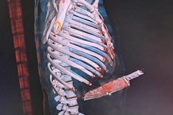 Cứu sống bệnh nhân bị dao đâm trúng bụng