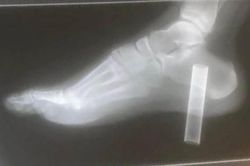 Suýt mất chân vì nghịch thuốc lá điện tử