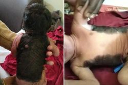 Hi hữu: Cậu bé sinh ra đã có lông, tóc khắp nửa người
