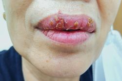 Bị nhiễm trùng nặng vì xăm môi cấp tốc đón Tết