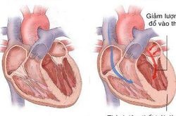 Lối sống lành mạnh giúp ngăn ngừa suy tim